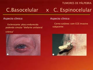 Aspecto clinico:
Esclerosante: placa endurecida
podendo simular “blefarite unilateral
crônica”
C.Basocelular x C. Espinocelular
TUMORES DE PÁLPEBRA
Aspecto clinico:
Corno cutâneo: com CCE invasivo
subjacente
 