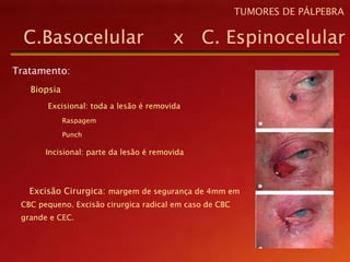 Tratamento:
Biopsia
Excisional: toda a lesão é removida
Raspagem
Punch
Incisional: parte da lesão é removida
Excisão Cirurgica: margem de segurança de 4mm em
CBC pequeno. Excisão cirurgica radical em caso de CBC
grande e CEC.
C.Basocelular x C. Espinocelular
TUMORES DE PÁLPEBRA
 