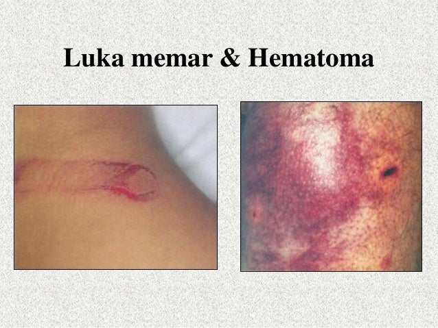 Cedera jaringan lunak