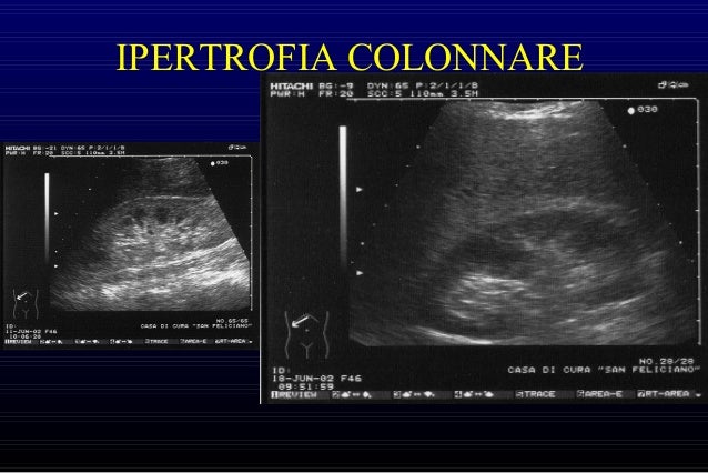 Rene Normale E Nefropatie Mediche E Chirurgiche
