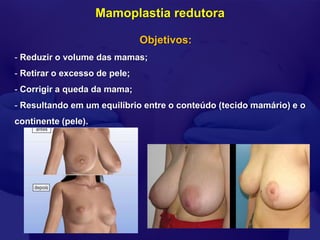 Mamoplastia redutora

                               Objetivos:
- Reduzir o volume das mamas;
- Retirar o excesso de pele;
- Corrigir a queda da mama;
- Resultando em um equilíbrio entre o conteúdo (tecido mamário) e o
continente (pele).
 