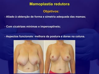 Mamoplastia redutora
                            Objetivos:
- Aliado à obtenção de forma e simetria adequada das mamas;


- Com cicatrizes mínimas e imperceptíveis;


- Aspectos funcionais: melhora da postura e dores na coluna.
 