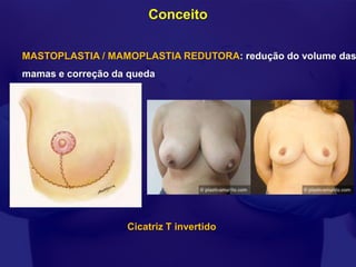Conceito

MASTOPLASTIA / MAMOPLASTIA REDUTORA: redução do volume das
mamas e correção da queda




                   Cicatriz T invertido
 