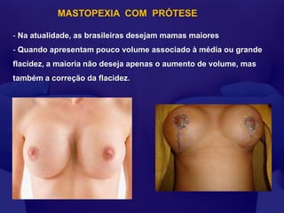 MASTOPEXIA COM PRÓTESE

- Na atualidade, as brasileiras desejam mamas maiores
- Quando apresentam pouco volume associado à média ou grande
flacidez, a maioria não deseja apenas o aumento de volume, mas
também a correção da flacidez.
 