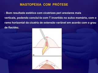 MASTOPEXIA COM PRÓTESE

- Bom resultado estético com cicatrizes peri areolares mais
verticais, podendo concluí-la com T invertido no sulco mamário, com o
ramo horizontal da cicatriz de extensão variável em acordo com o grau
de flacidez.
 