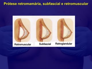 Prótese retromamária, subfascial e retromuscular




      Retromuscular   Subfascial   Retroglandular
 