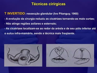 Técnicas cirírgicas

T INVERTIDO: ressecção glandular (Ivo Pitanguy, 1960)
- A evolução da cirurgia reduziu as cicatrizes tornando-as mais curtas;
- Não atinge regiões axilares e esternais;
- As cicatrizes localizam-se ao redor da aréola e de seu pólo inferior até
o sulco infra-mamário, sendo a técnica mais freqüente.
 