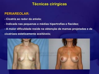 Técnicas cirírgicas

PERIAREOLAR:
- Cicatriz ao redor da aréola;
- Indicada nas pequenas e médias hipertrofias e flacidez;
- A maior dificuldade reside na obtenção de mamas projetadas e de
cicatrizes esteticamente aceitáveis;
 