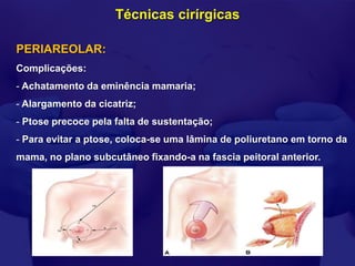 Técnicas cirírgicas

PERIAREOLAR:
Complicações:
- Achatamento da eminência mamaria;
- Alargamento da cicatriz;
- Ptose precoce pela falta de sustentação;
- Para evitar a ptose, coloca-se uma lâmina de poliuretano em torno da
mama, no plano subcutâneo fixando-a na fascia peitoral anterior.
 