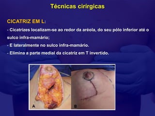Técnicas cirírgicas

CICATRIZ EM L:
- Cicatrizes localizam-se ao redor da aréola, do seu pólo inferior até o
sulco infra-mamário;
- E lateralmente no sulco infra-mamário.
- Elimina a parte medial da cicatriz em T invertido.
 