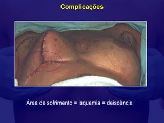 Complicações




Área de sofrimento = isquemia = deiscência
 