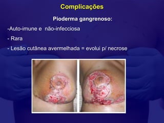 Complicações
                 Pioderma gangrenoso:
-Auto-imune e não-infecciosa
- Rara
- Lesão cutânea avermelhada = evolui p/ necrose
 