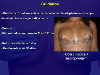 Cuidados

- Curativos: Curativos elásticos especialmente adaptados a cada tipo
de mama, trocados periodicamente.


-Pontos:
-São retirados em torno do 7º ao 10º dia.


-Retorna a atividade física:
- Geralmente após 90 dias.

                                               Cola cirúrgica +
                                               microporagem
 