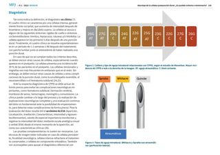 / # 3 / 2023
MPJ SEMDOR
SEMDOR
Abordaje de la cefalea postpunción dural. ¿Es posible evitarla o minimizarla? 108
Diagnóstico
Tal como indica la definición, el diagnóstico es clínico (7).
El cuadro clínico se caracteriza por una cefalea intensa, general-
mente fronto-occipital, que aumenta de intensidad después de
levantarse y mejora en decúbito supino. La cefalea se asocia a
alguno de los siguientes síntomas: rigidez de cuello o síntomas
cocleovestibulares: tinnitus, hipoacusia, náuseas y/o fotofobia. La
cefalea aparece en los primeros 5 días después de una punción
dural. Finalmente, el cuadro clínico se resuelve espontáneamen-
te en un periodo de 1-2 semanas o 48 después del tratamiento
con parche lumbar junto al antecedente de haber realizado una
punción dural.
En caso de que no se cumplan todos los criterios descritos,
se deben excluir otras causas de cefalea, especialmente cuando
aparece en el postparto. La cefalea presenta una incidencia del
39 % de las pacientes en el postparto. Las cefaleas tensionales y
migrañas son más frecuentes en embarazo que en el resto. Sin
embargo, se deben excluir otras causas de cefalea u otras compli-
caciones de la punción dural, como la encefalopatía reversible, el
neumoencéfalo o el hematoma subdural (24,25).
Ante la sospecha diagnóstica de CPPD se debe actuar de
forma precoz para evitar las complicaciones neurológicas im-
portantes, como hematoma subdural, herniación cerebral,
trombosis de senos, hemorragias, meningitis y convulsiones. La
clínica puede cambiar a lo largo del proceso y la realización de
exploraciones neurológicas completas y una evaluación continua
del dolor es fundamental ante la posibilidad de empeoramien-
to, para detectar estas complicaciones de forma precoz. Para la
evaluación del dolor resulta útil el acrónimo ALICIA (Aparición,
Localización, Irradiación, Características, Intensidad y Agravan-
tes/Atenuantes), siendo de especial importancia monitorizar y
registrar la intensidad del dolor mediante escala analógica visual
o verbal (EVA) desde el mismo momento de la aparición, así
como sus características clínicas (26).
Las pruebas complementarias no suelen ser necesarias. Las
técnicas de imagen están indicadas en caso de cefalea persisten-
te, focalidad neurológica, cefalea intensa refractaria al tratamien-
to conservador, o cefalea sin componente ortostático. También
son aconsejables para apoyar el diagnóstico diferencial con
Figura 2. Calibre y tipo de aguja intradural relacionados con CPPD, según el estudio de Maranhao. Mayor inci-
dencia de CPPD a más a la derecha de la imagen. AT: aguja atraumática. C: bisel cortante.
26G
AT
27G
AT
29G
C
24G
AT
22G
AT
25G
AT
23G
C
22G
C
27G
C
26G
C
Figura 3. Tipos de aguja intradural. Whitacre y Sprotte son atraumáti-
cas (perforación lateral).
 