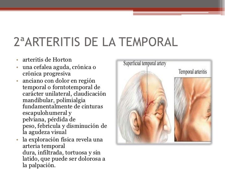 arteritis temporal de horton