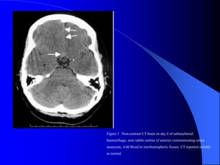 Figure 3 Non-contrast CT brain on day 6 of subarachnoid
haemorrhage; note subtle outline of anterior communicating artery
aneurysm, with blood in interhemispheric fissure. CT reported initially
as normal.
 