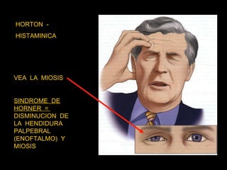 HORTON  -  HISTAMINICA VEA  LA  MIOSIS  SINDROME  DE HORNER  =  DISMINUCION  DE LA  HENDIDURA PALPEBRAL (ENOFTALMO)  Y MIOSIS  