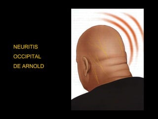 NEURALGIA OCCIPITAL NEURITIS  OCCIPITAL  DE ARNOLD 