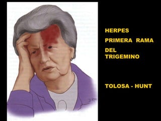 HERPES  PRIMERA  RAMA  DEL  TRIGEMINO TOLOSA - HUNT  