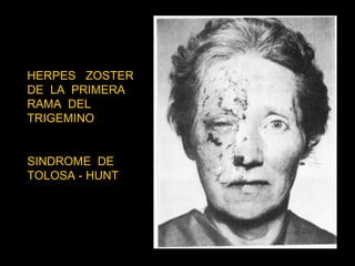 HERPES  ZOSTER DE  LA  PRIMERA RAMA  DEL TRIGEMINO  SINDROME  DE TOLOSA - HUNT  