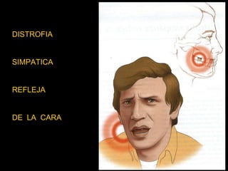 DISTROFIA  SIMPATICA  REFLEJA DE  LA  CARA 