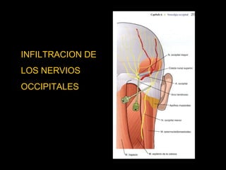 INFILTRACION DE  LOS NERVIOS  OCCIPITALES 