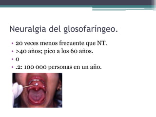 Neuralgia del glosofaríngeo.
• 20 veces menos frecuente que NT.
• >40 años; pico a los 60 años.
• 0
• .2: 100 000 personas en un año.
 