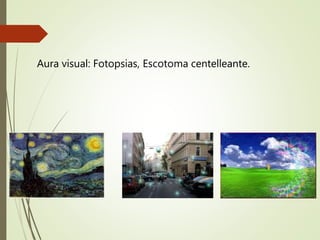 Aura visual: Fotopsias, Escotoma centelleante.
 