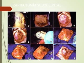 CRANIECTOMÍA SUBOCCIPITAL
 