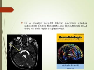  En la neuralgia occipital deberán practicarse estudios
radiológicos simples, tomografía axial computarizada (TAC)
o una RM de la región occipitocervical.
 