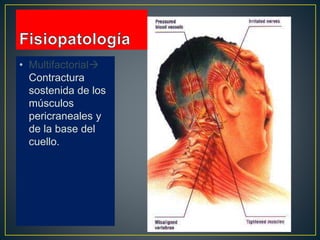 • Multifactorial
Contractura
sostenida de los
músculos
pericraneales y
de la base del
cuello.
 