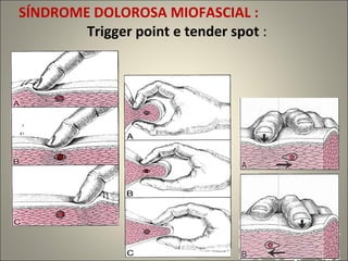 SÍNDROME DOLOROSA MIOFASCIAL :  Trigger point e tender spot  : 