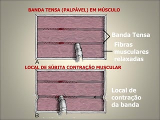 BANDA TENSA (PALPÁVEL) EM MÚSCULO Banda Tensa Fibras  musculares relaxadas LOCAL DE SÚBITA CONTRAÇÃO MUSCULAR  Local de  contração  da banda 