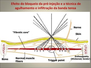 Efeito do bloqueio da pré-injeção e a técnica de agulhamento e infiltração da banda tensa “ Fibrotic core” Nerve Skin Bone Normal muscle fibers Trigger point Enthesopathy (thickened, tender) 