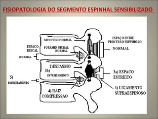 FISIOPATOLOGIA DO SEGMENTO ESPINHAL SENSIBILIZADO  
