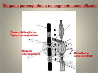 Bloqueio  Interespinhoso Dessensibilização do Espaço paraespinhoso Dermátomo correspondente Bloqueio paraespinhoso no segmento sensibilizado 