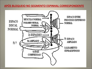 APÓS BLOQUEIO NO SEGMENTO ESPINHAL CORRESPONDENTE 