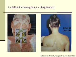 Cefaléia Cervicogênica - Diagnóstico Extraído de  Raffaelli Jr.,Edgar , O Exame Cefaliátrico Sinal de Luschka 