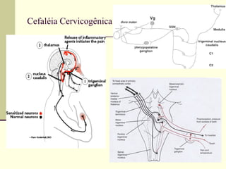   Cefaléia Cervicogênica  