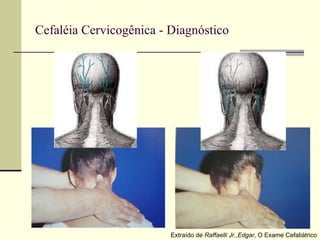 Cefaléia Cervicogênica - Diagnóstico Extraído de  Raffaelli Jr.,Edgar , O Exame Cefaliátrico 