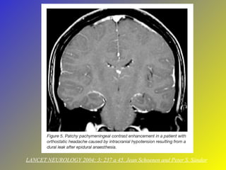 LANCET NEUROLOGY 2004; 3; 237 a 45, Jean Schoenen and Peter S. Sándor 