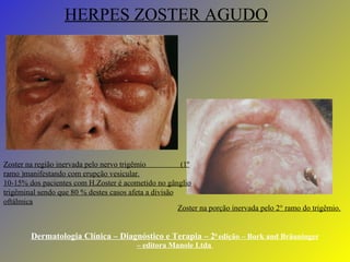 Dermatologia Clínica – Diagnóstico e Terapia – 2 0  edição – Bork and Bräuninger – editora Manole Ltda  HERPES ZOSTER AGUDO Zoster na região inervada pelo nervo trigêmio  (1 º ramo )manifestando com erupção vesicular. 10-15% dos pacientes com H.Zoster é acometido no gânglio trigêminal sendo que 80 % destes casos afeta a divisão oftálmica Zoster na porção inervada pelo 2 ° ramo do trigêmio. 