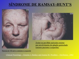 SÍNDROME DE RAMSAY-HUNT’S Clinical Neurology – Graeme J. Hankey and Joanna M. Wardlaw – Ed.Demos –2002 Paresia do VII nervo craniano à esquerda Zoster no pavilhão auricular externo por envolvimento do gânglio geniculado (mesmo paciente à esquerda)  