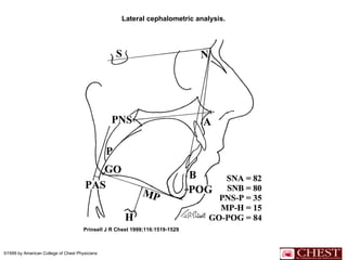 Lateral cephalometric analysis. Prinsell J R Chest 1999;116:1519-1529 ©1999 by American College of Chest Physicians 