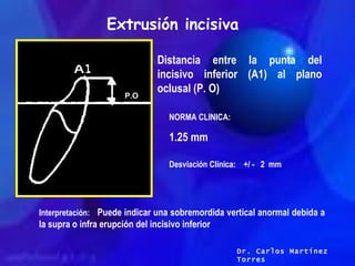 Extrusión incisiva Distancia entre la punta del incisivo inferior (A1) al plano oclusal (P. O) NORMA CLINICA: 1.25 mm Desv...