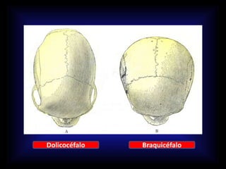 Dolicocéfalo Braquicéfalo
 