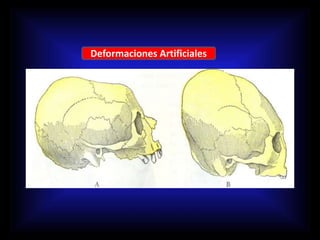 Deformaciones Artificiales
 