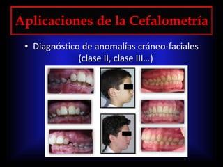 Aplicaciones de la Cefalometría
• Diagnóstico de anomalías cráneo-faciales
(clase II, clase III…)
 