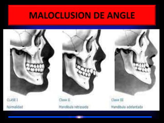 MALOCLUSION DE ANGLE
 