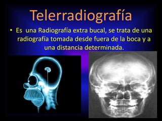 Telerradiografía
• Es una Radiografía extra bucal, se trata de una
radiografía tomada desde fuera de la boca y a
una distancia determinada.
 